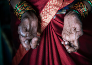 Leprosy & stigma: A tough battle to win in India