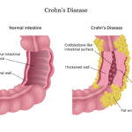 New trial in Glasgow University offers hope for Crohn’s disease patients