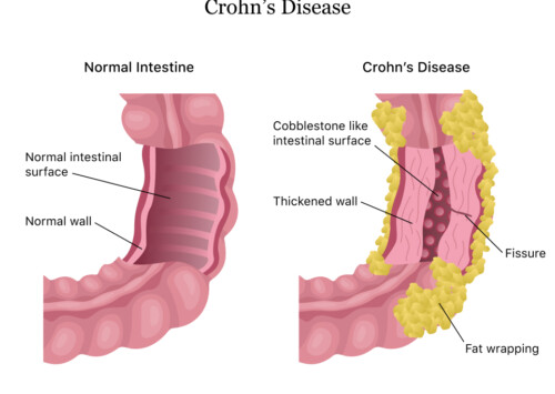 New trial offers hope for Crohn’s disease patients