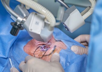 Clear vision ahead: Lasik surgery reshaping eye care in India